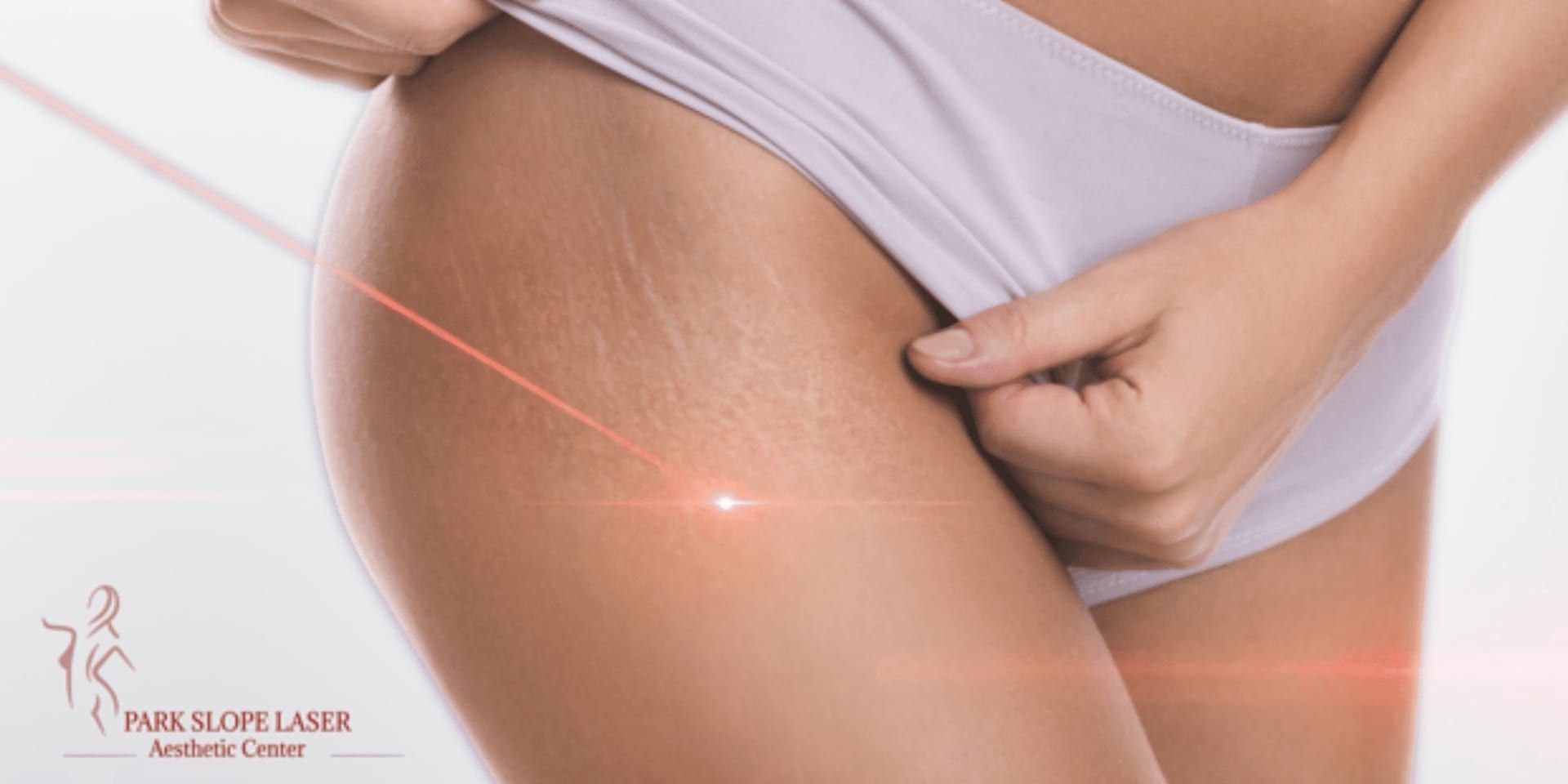 stretch mark removal