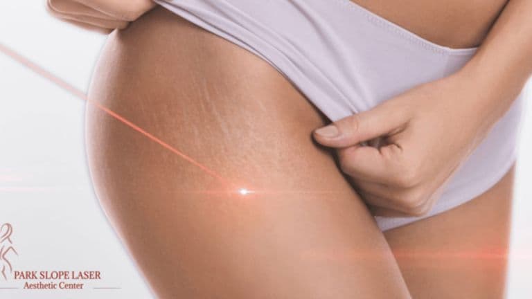 stretch mark removal